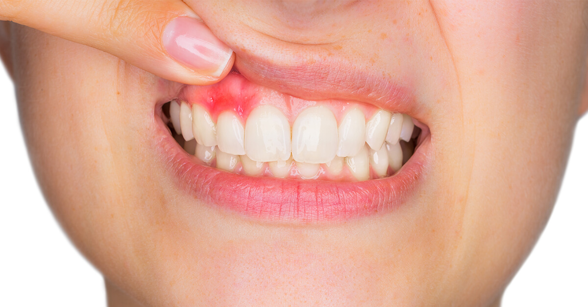 Red, inflamed gums can be a warning sign of periodontal disease.