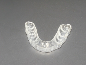 Mouthguard to prevent teeth grinding for Anchorage and Wasilla patients.