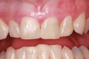 Close up photo of periodontal disease which can be treated using advanced dental technology.