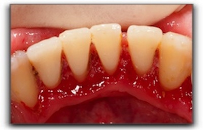 Gum disease treatment in Anchorage and Wasilla