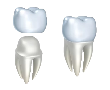 Dental crowns paitent with dentist in Anchorage