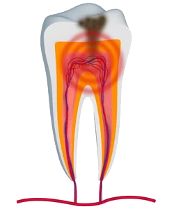 Infected tooth in urgent need of a root canal in Anchorage or Wasilla, AK.