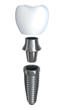 Disassembled tooth implant in Anchorage image