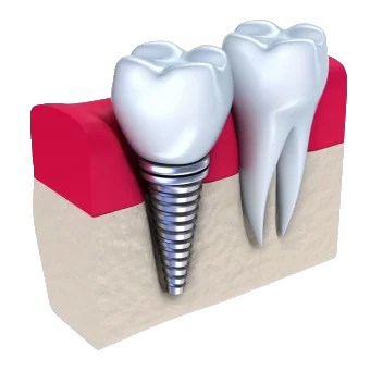 dental implant demonstration graphic for dental implants in Anchorage