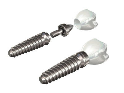 Dental implant parts explained for tooth implants in Anchorage or Wasilla