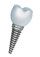 Close up photo of a tooth implant in Anchorage or Wasilla, AK.