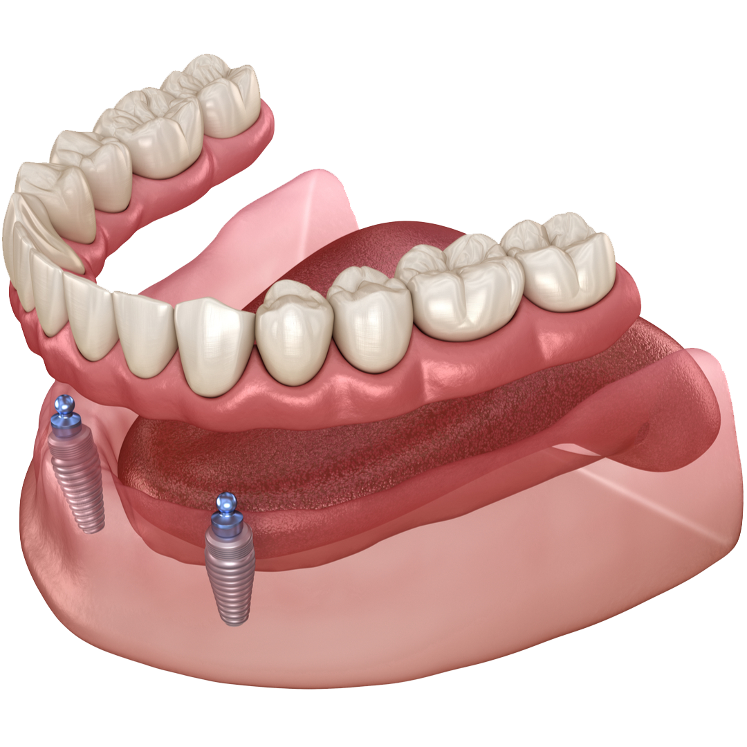 Implant supported dentures explanation for dentures in Anchorage