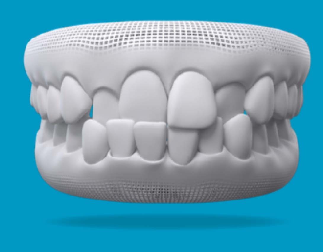 Crossbite