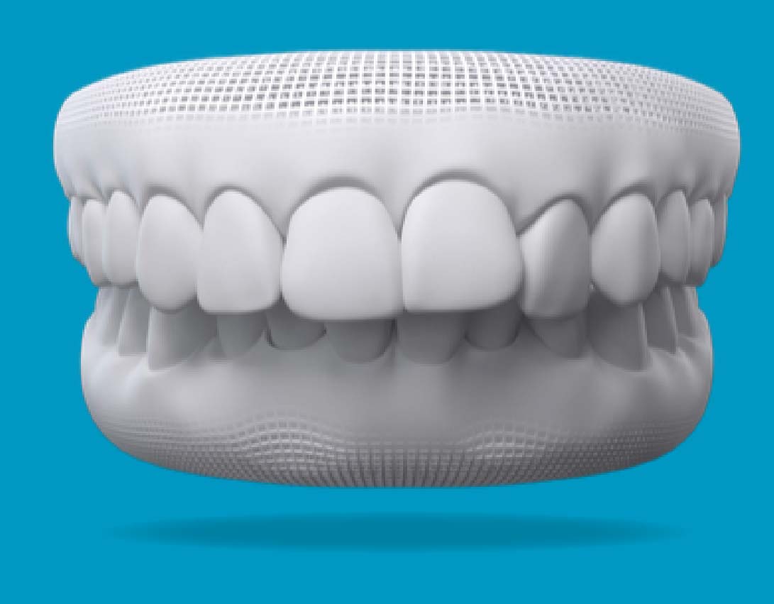 Overbite
