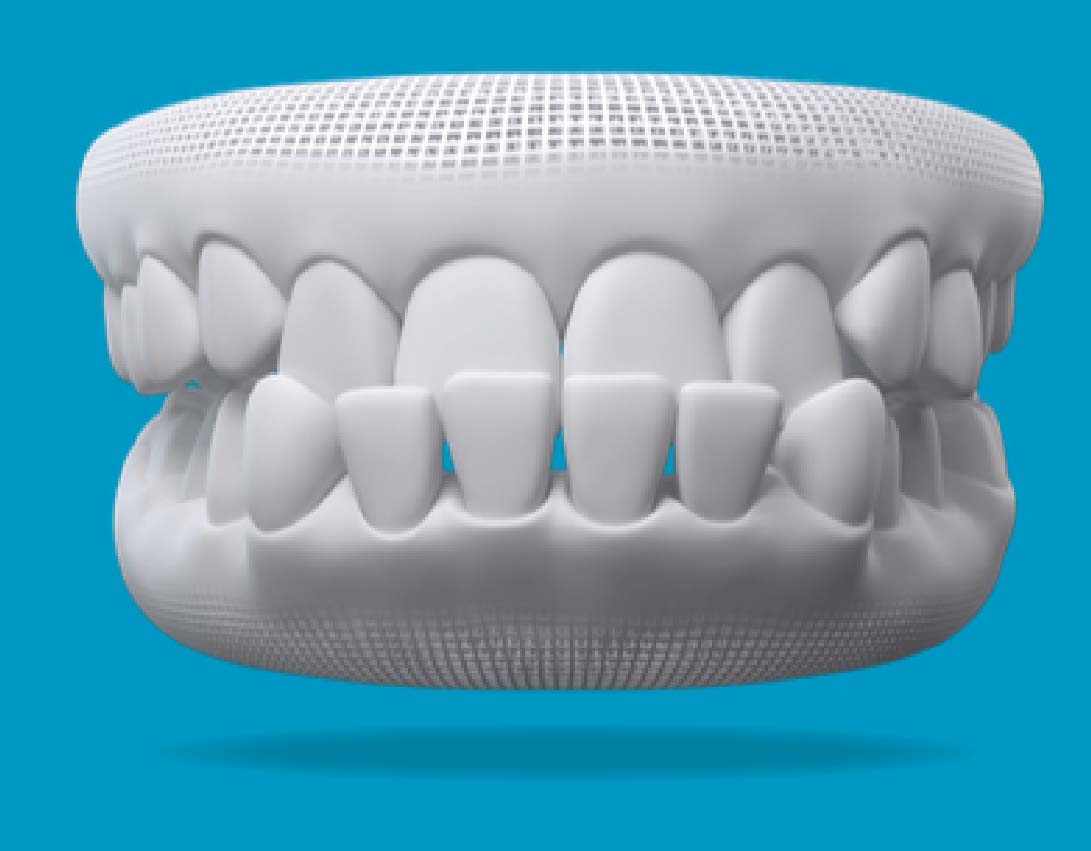 Underbite